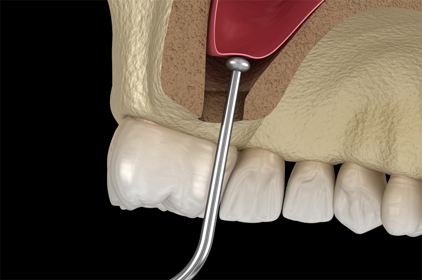 sinus1