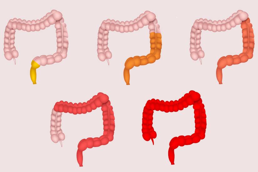 rectocolita_ulcerohemoragica