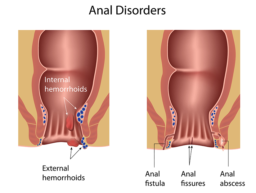 Abcesul Anal Si Fistula Anala Regina Maria