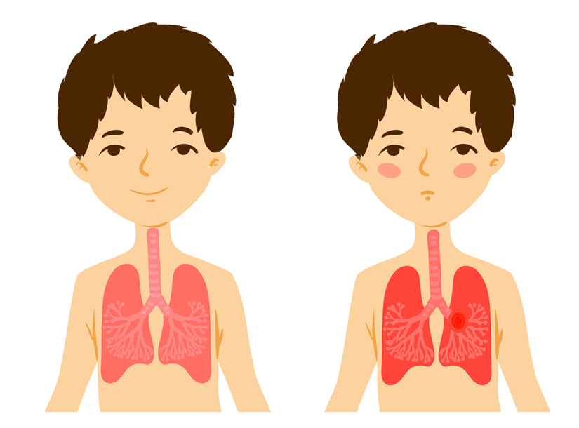 Pneumonia Bacteriana La Copii Se Poate Complica Cu Pleurezie Cand