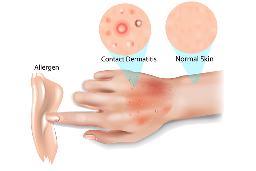 Boli Comune De Piele Dermatita De Contact Regina Maria