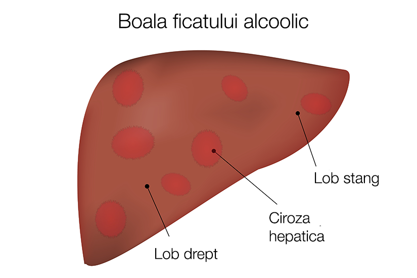 Boala ficatului alcoolic