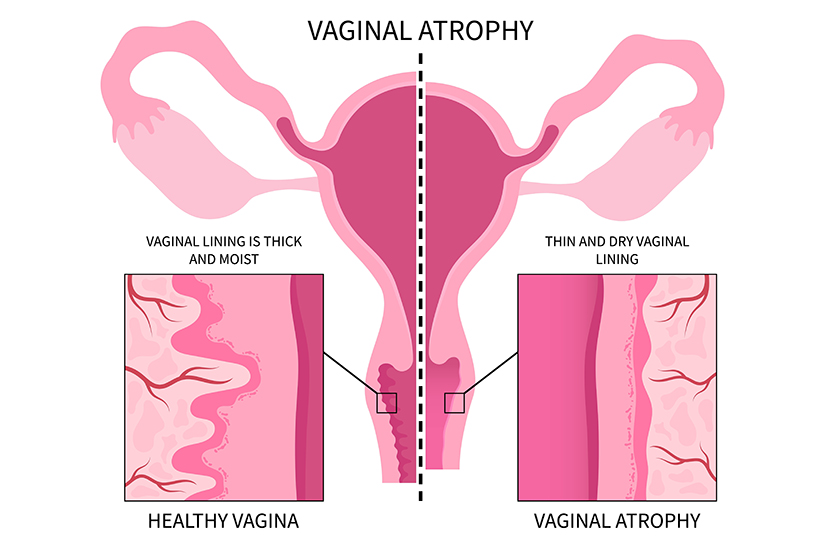 menopauza