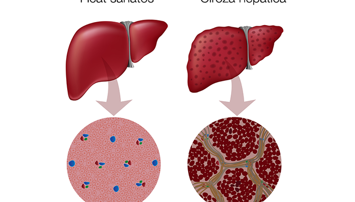 Ciroza hepatica  Reginamaria.ro