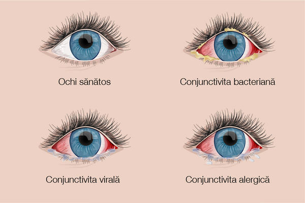 Conjunctivita Totul Despre Afectiunea Inflamatorie A Conjunctivei Reginamariaro 4597